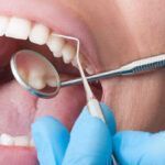 Implantes dentales