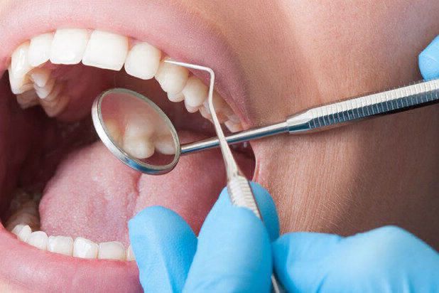 Implantes dentales