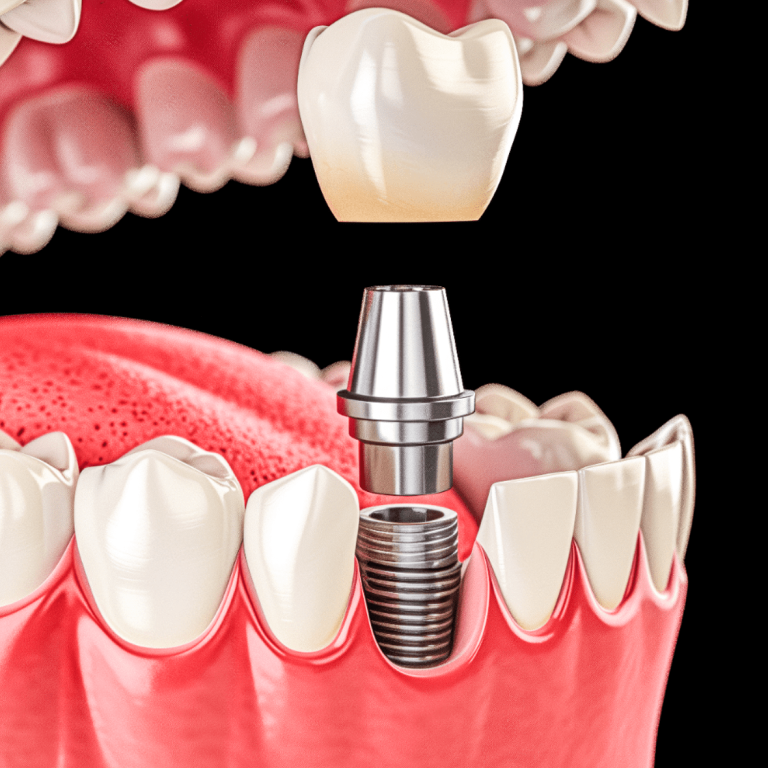 implantes